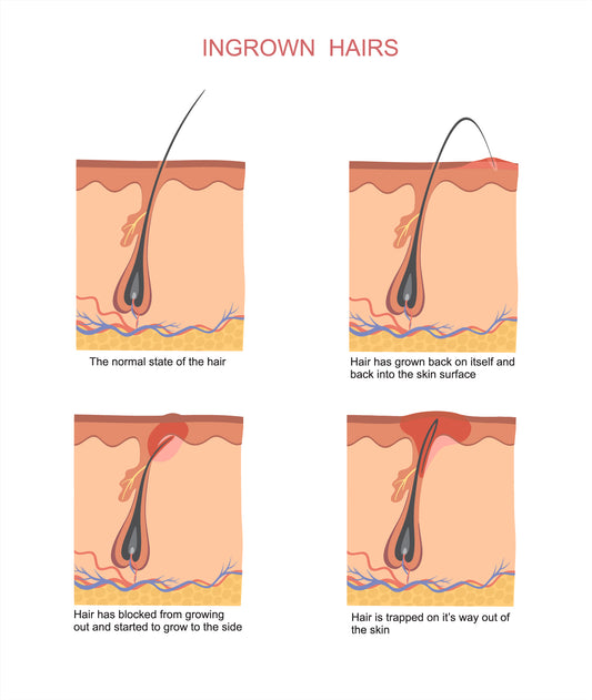 How to prevent ingrown hairs